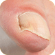 Fungal Nail Infection